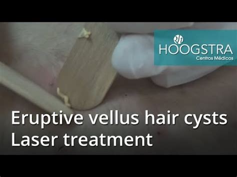 Eruptive Vellus Hair Cysts Laser Treatment Youtube