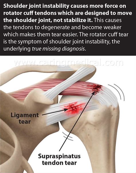 How To Fix A Shoulder Ligament Tear - Margaret Greene Kapsels