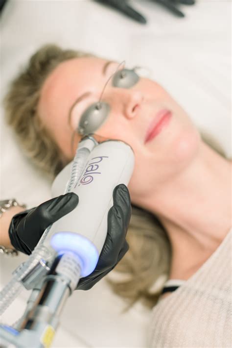 Halo Fractional Laser The Ultimate Guide To The Laser Skin Treatments