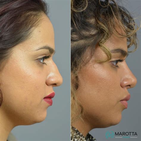 Nose Surgery Before After Patient Dr Marotta