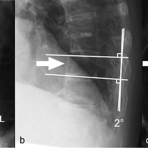 Anteroposterior A And Lateral B Plain Radiographs Immediately After Download Scientific