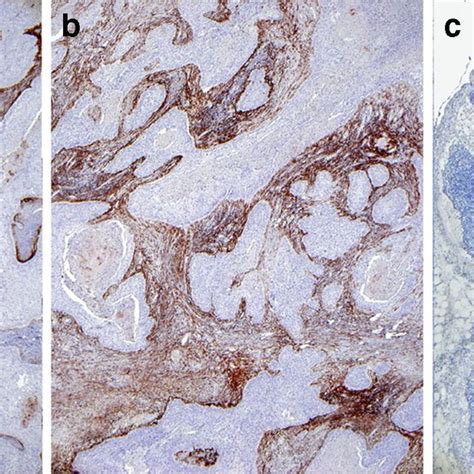 Immunohistochemistry of resected tissue from patient #4. FAP alpha ...