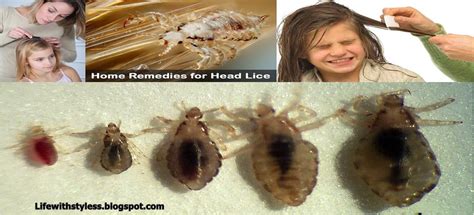 5 Best Home Remedies For Killing Lice Life With Styles