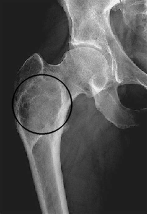 Polyostotic Fibrous Dysplasia Of Bone