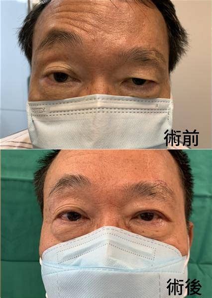 臉部受傷竟變「大小眼」困擾10年！醫生一招治好 有效改善眼瞼下垂 太報 Line Today