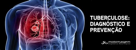 Diagnóstico E Prevenção Da Tuberculose Mobimagem