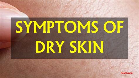 Symptoms Of Dry Skin Youtube