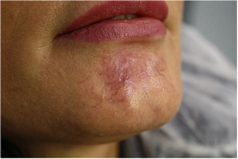 Novel Management Of Granuloma Formation Secondary To Dermal Filler A