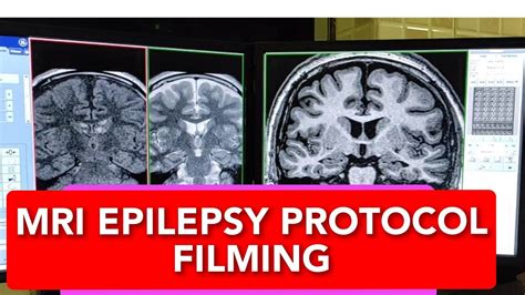 Brain Epilepsy Tle Protocol Filming Youtube