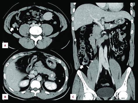 Contrast Enhanced Abdominal Computed Tomography Axial A At The Lower