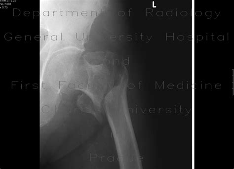 Radiology case: Pertrochanteric fracture, comminuted