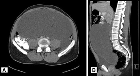 gastrointestinale Hämangiomatose pacs