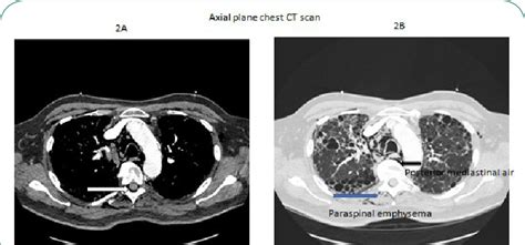 A & B: Axial planes of chest CT scan showing posterior... | Download ...