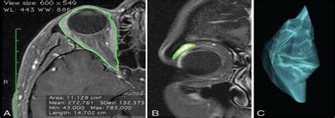 Normal Lacrimal Gland Volumes By Magnetic Resonance Imaging