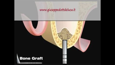 Mini Sinus Lift Rialzo Seno Mascellare Per Via Crestale Demostration