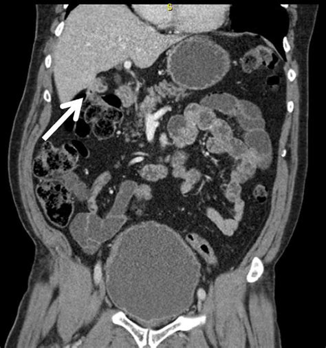 Shows an area of inflammatory reaction between the hepatic flexure and ...