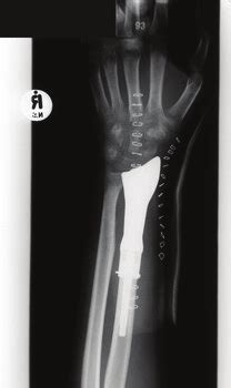 Orthopaedic Distal Radius Arthroplasty (Courtesy of ISIQU) | Download ...