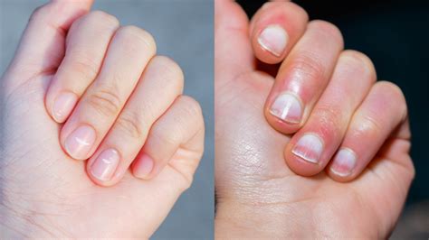 Do Your Nails Look Strange 4 Possible Causes Of Pale Nail Beds White