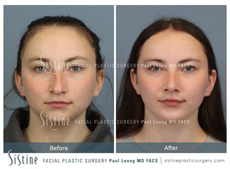 Chin Implant Before And After Sistine Facial Plastic Surgery