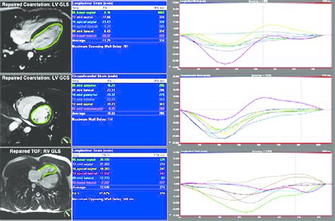 Cardiovascular Magnetic Resonance Feature Tracking In Patients With Download Scientific Diagram