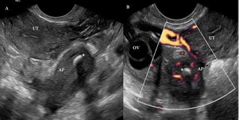 Transvaginal Imaging Of The Right Adnexa Demonstrating Appendicitis Download Scientific