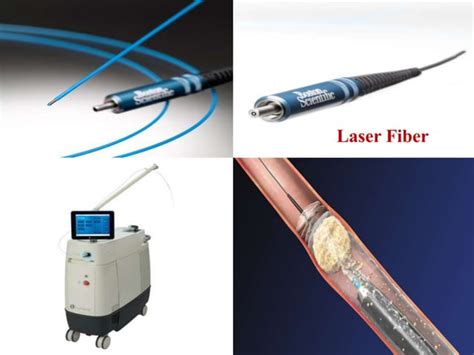 Laser Lithotripsypptx
