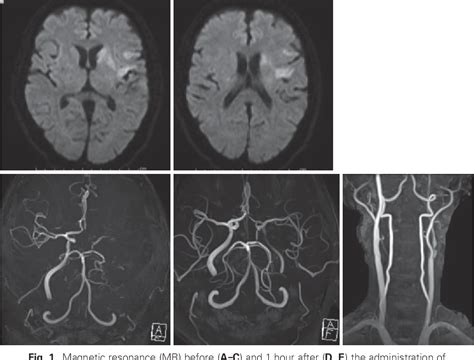 Figure From A Case Of Carotid Free Floating Thrombus Longitudinally