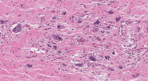 Undifferentiated Pleomorphic Sarcoma Atlas Of Pathology