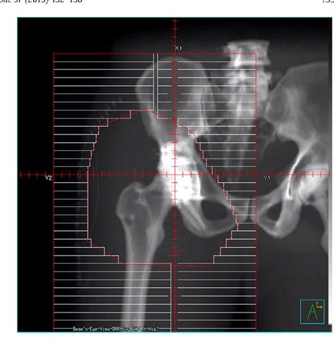 Table 1 From Computerized Tomography Based Radiotherapy Improves