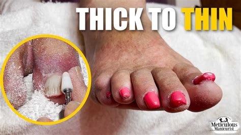 How To Improve Deformed Toenails Youtube