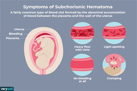 O Que Um Hematoma Subcori Nico