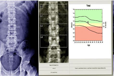 Densitometr A Sea C Mo Y Por Qu Se Realiza Mejor Con Salud