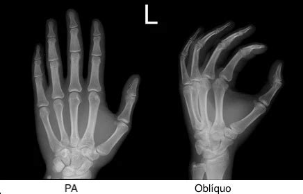 Radiografia De M O E Do Punho Saiba Mais Medway