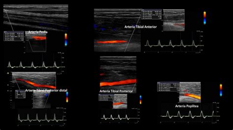 Flujos Doppler E Im Genes Que Se Deben Conocer Parte Flujo Doppler