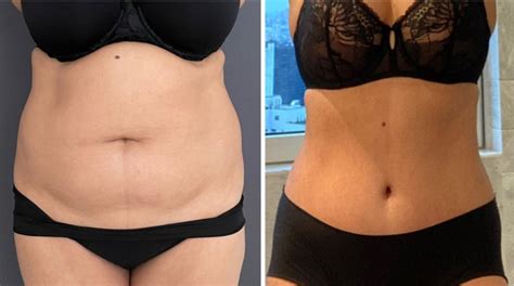 Abdominoplasty Before And After Photos