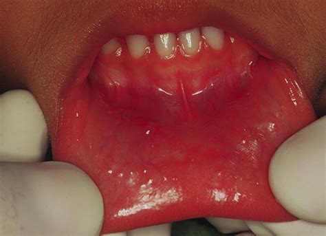 Mucous Cyst Lip