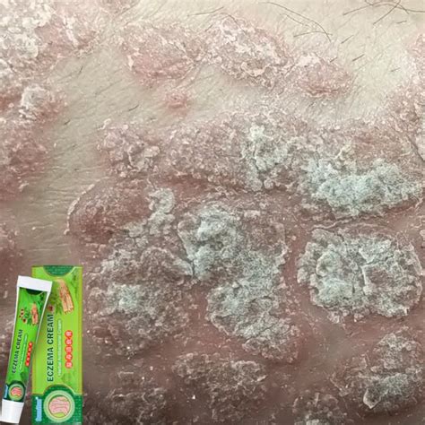 Eczema Cream Ubat Gatal Krim Psoriasis Cream Krim Gatal Eczema