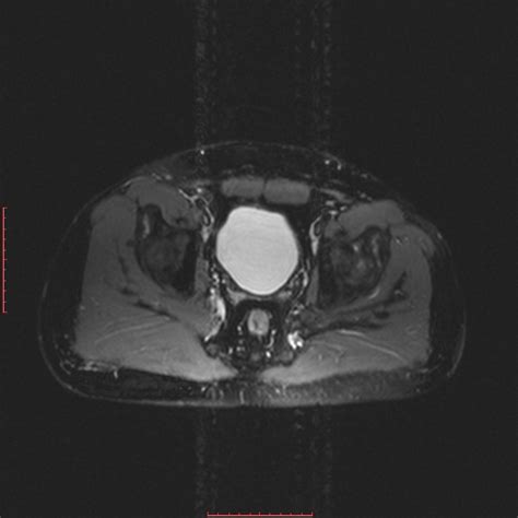 Radiopaedia Case Avascular Necrosis Bilateral Hips Id 57481 Study