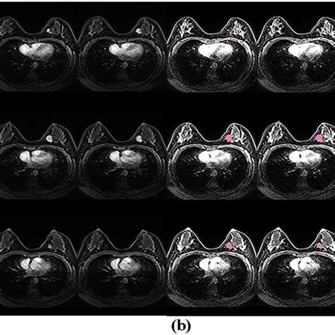 A Fat Saturated T1 Weighted Images With Gadolinium Enhancement In A Download Scientific