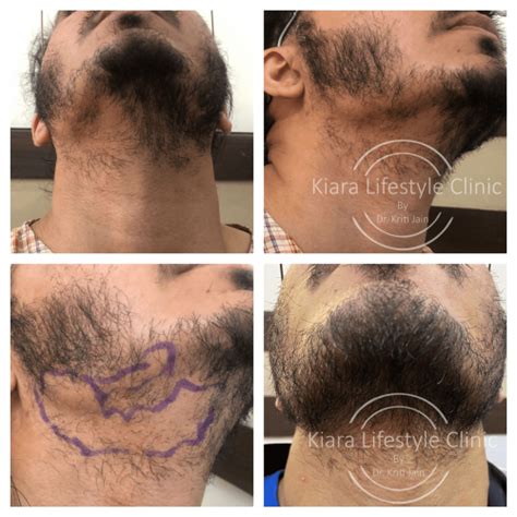 Kiara Clinic Best Beard Transplant In Delhi Facial Hair