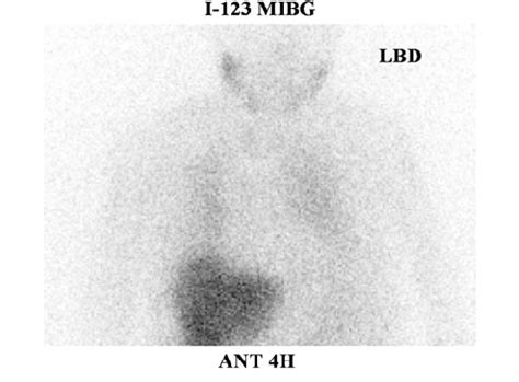 An Anterior View At 4 H After Injection Of 111 MBq Of 123 I MIBG MIBG