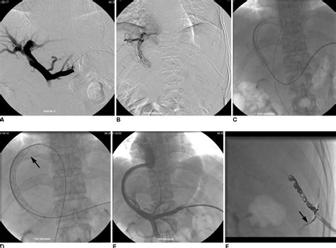 Figure From Recanalization Of An Occluded Intrahepatic Portosystemic