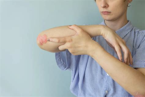 Expert Psoriasis Treatment and Online Dermatology Solutions