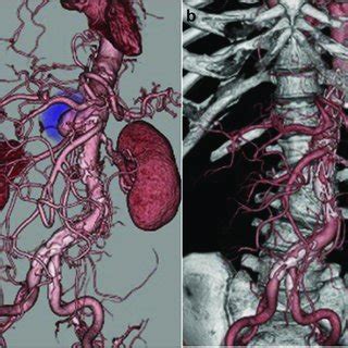 Three Dimensional Contrast Enhanced Computed Tomography Showing A 50 Mm