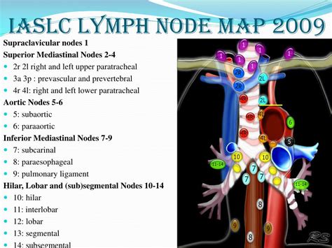 Lymph Node Cancer Stages Hot Sex Picture