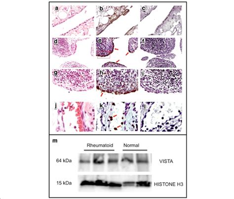 Immunoreactive VISTA Is Detected In Human Synovium Tissue Sections And