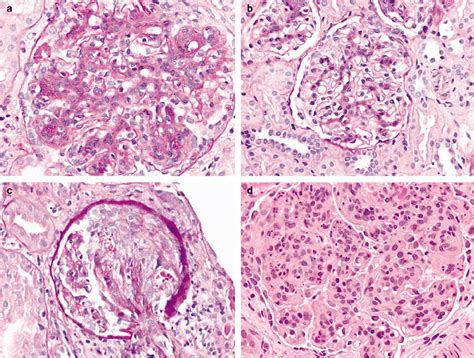 Pathology Outlines Membranoproliferative Glomerulonephritis Types I Iii