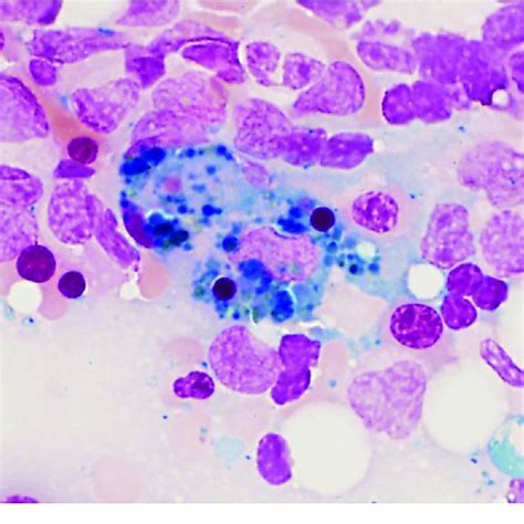 Bone Marrow Aspirate Showing Two Macrophages That Have Ingested A