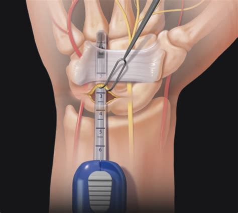 Cirurgia da mão minimamente invasiva Tratamento seguro recuperação