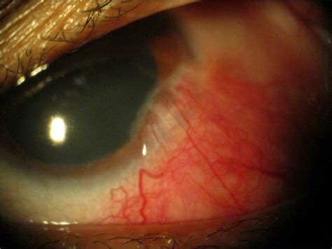 Recurrent Scleritis Showing Conjunctival Mass Encroaching Peripheral Download Scientific